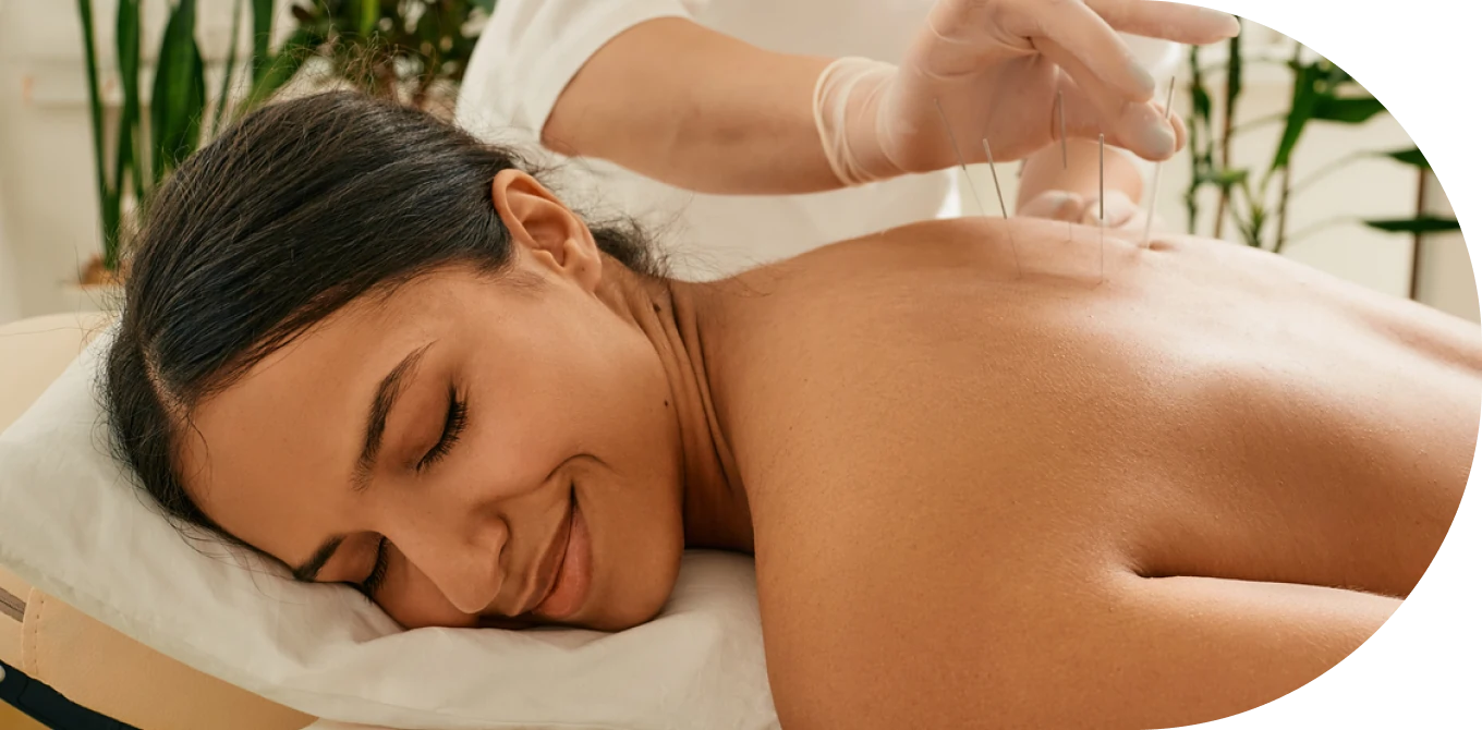 Mulher recebendo tratamento de acupuntura para dor nas costas